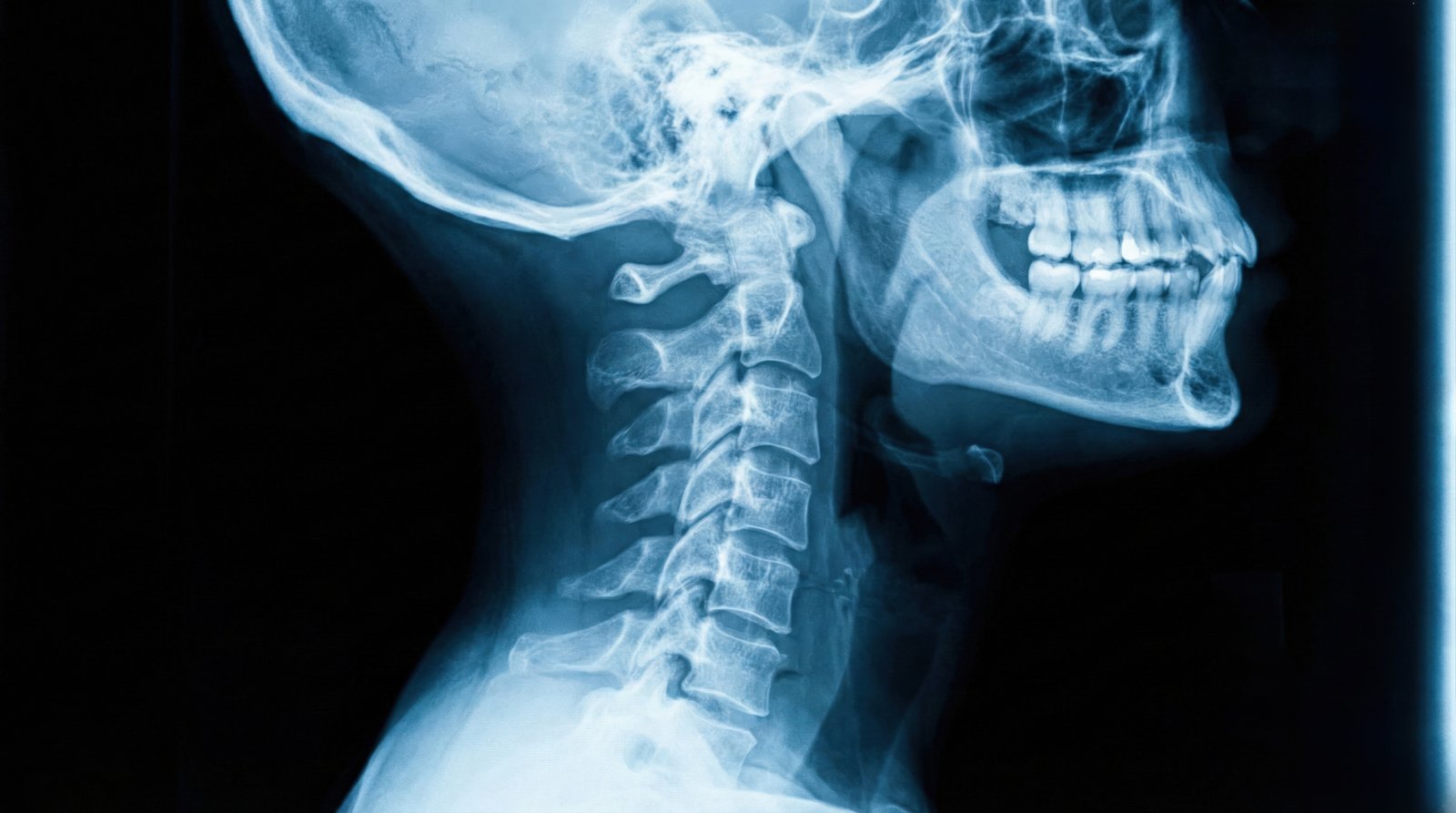 Side-view X-ray of the head and neck showing the stacked vertebrae of the cervical spine