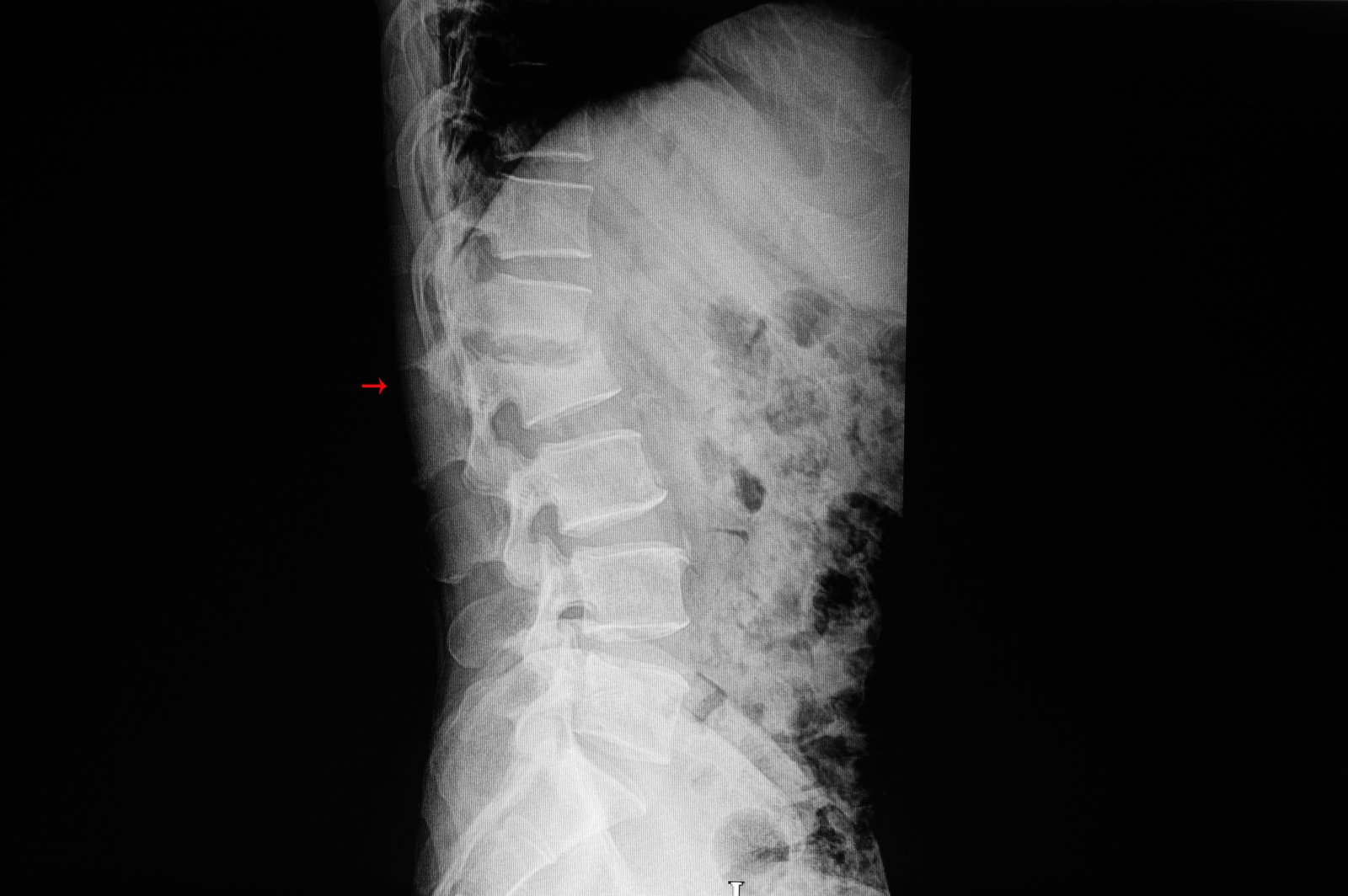 An X-ray of the lumbar spine showing a compression fracture