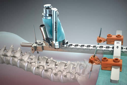 robot assisted spine surgery