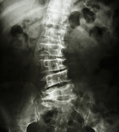 scoliosis-treatment-nyc