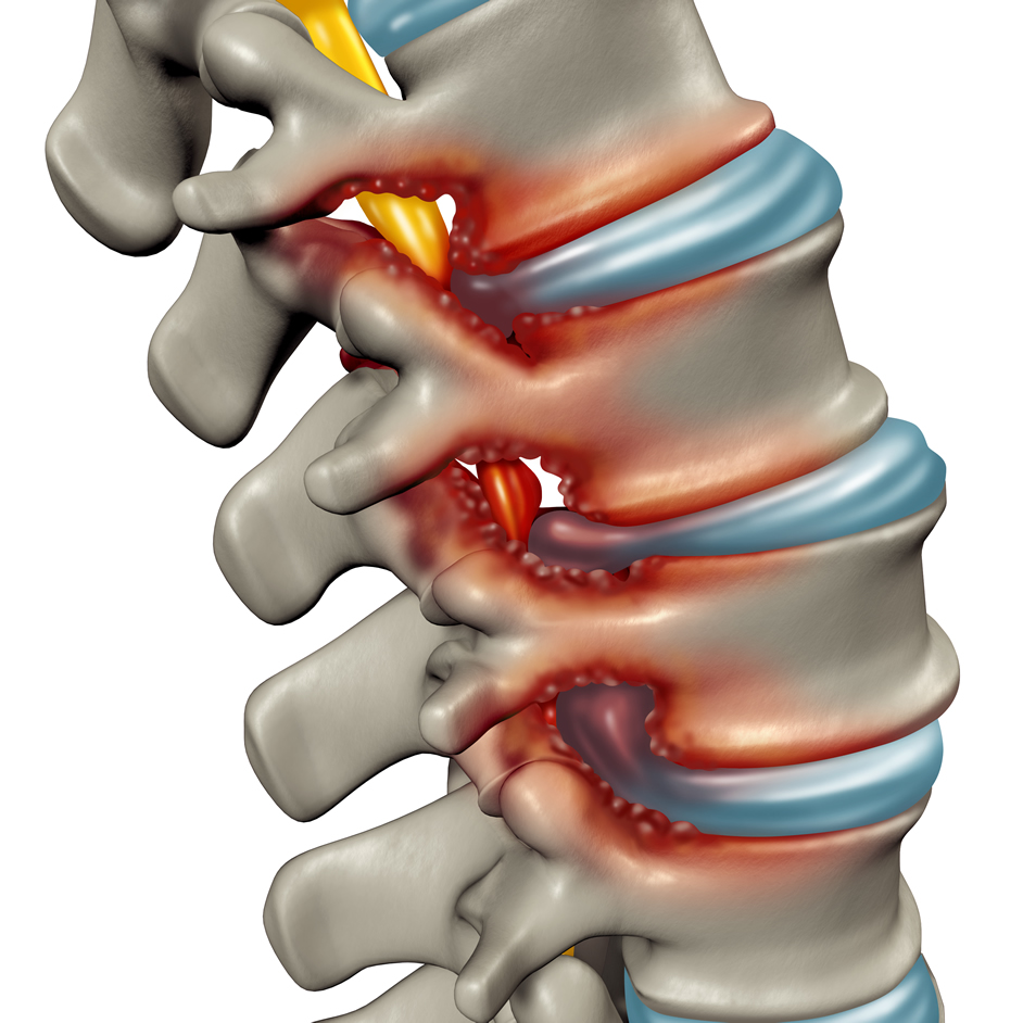 Minimally Invasive Lumbar Fusion