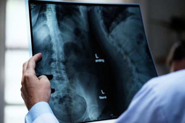 Understanding Minimally Invasive Lumbar Fusion Surgery