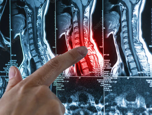What You Should Know About Cervical Myelopathy