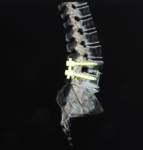 spine 3d xray showing spine fusion