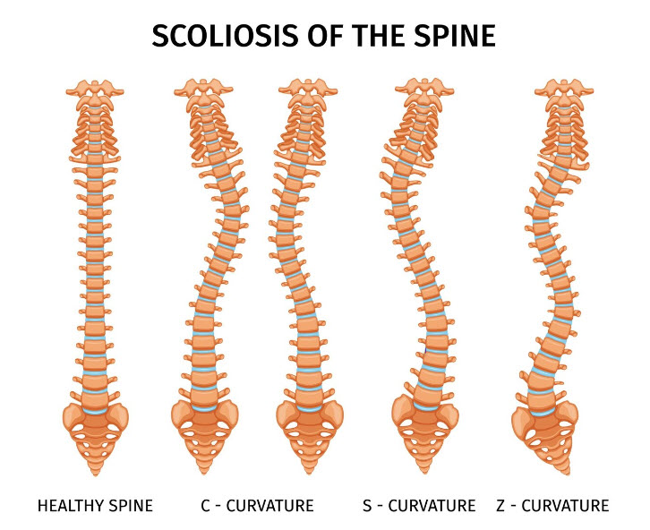 Different Treatments for Scoliosis